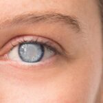 Tips on how to diagnose and treat cataracts